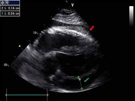 Effusive Constrictive Pericarditis Current Perspectives JVD