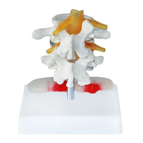 2 Section Human Lumbar Vertebra With Diseased Intervertebral Disc Model