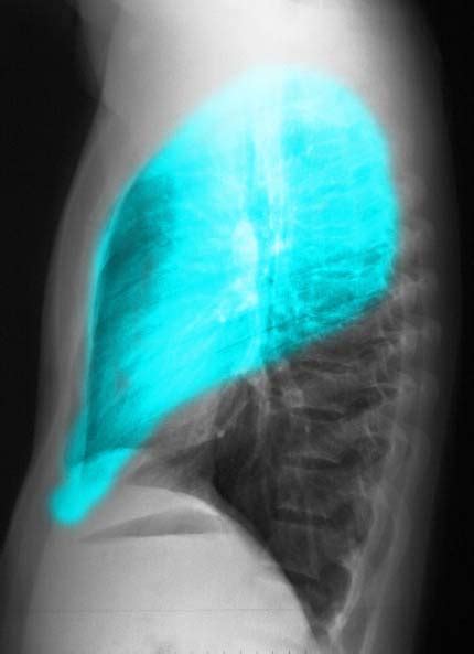 Chest X Ray Lung Parts And Fissures CXR Lungs