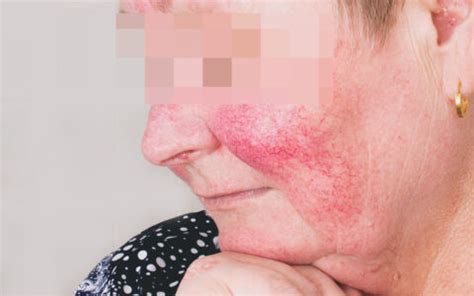 Rosacea Behandeln Laser Berlin Yag Couperose LaserAesthetik Berlin Mitte