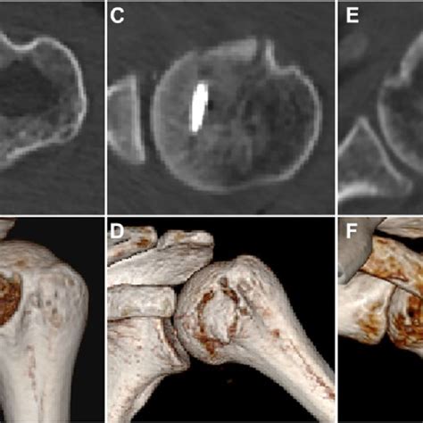 Preoperative Imaging A The Radiograph Showing That The Cortex Of The