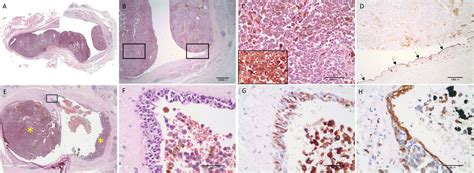 Frontiers Primary Malignant Melanoma Of The Parotid Gland A Rare