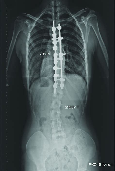 Juvenile Idiopathic Scoliosis Treated With Posterior Arthrodesis And Segmental Pedicle Screw