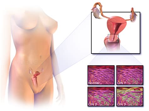 Carcinoma A Cellule Basali Adenoide Della Cervice Uterina