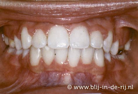 Scheve Tanden Alkmaarse Orthodontisten