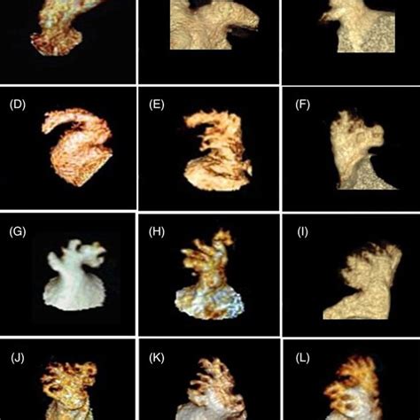 Various Morphologies Of The Left Atrial Appendage A‐d Simple Left