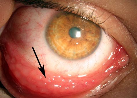 Chlamydia In Eye