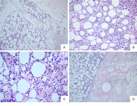 Figure 1 from Subcutaneous panniculitis-like T-cell lymphoma with hemophagocytic syndrome : a ...