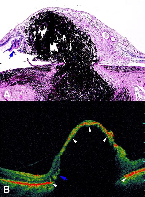 Optical Coherence Tomography Pathology Correlation Of Optic Disc Melanocytoma Ophthalmology