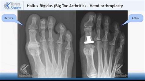 Big Toe Joint Replacement Orthopaedic Foot And Ankle Surgeon