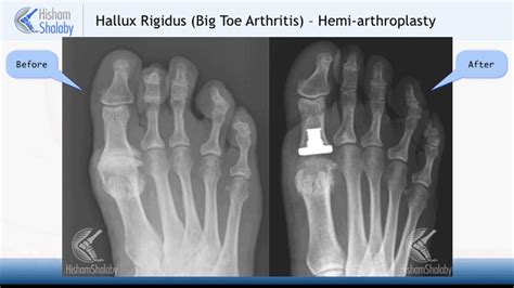 Big Toe Joint Replacement – Mr Hisham Shalaby