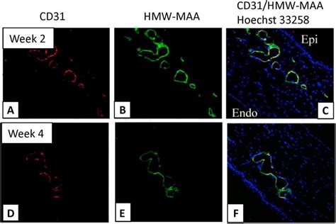 Immunostaining Of CD31 And Highmolecular Weight Melanoma Associated