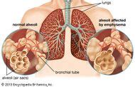 Bullous emphysema | pathology | Britannica.com