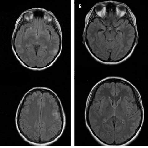 Cranial Magnetic Resonance Imaging Of Case 1 Before And After Download Scientific Diagram