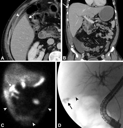 Multimodality Imaging Of Cholecystectomy Complications Radiographics