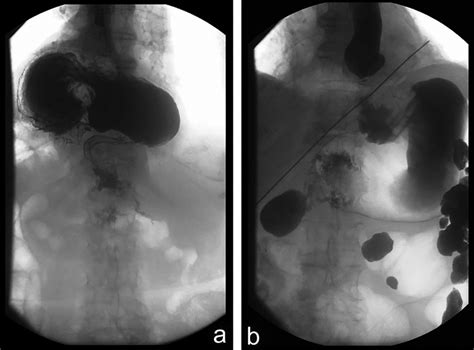 Paraesophageal Hernia Barium Swallow