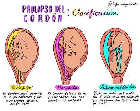 Prolapso del cordon umbilical Clasificación Enfermera Presente uDocz