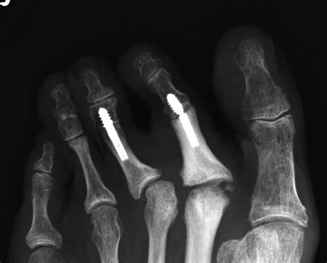 Radiographic Analysis Of Proximal Interphalangeal Joint, 50% OFF