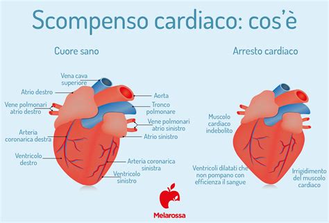 Scompenso cardiaco cosè tipologie sintomi cause diagnosi e terapia