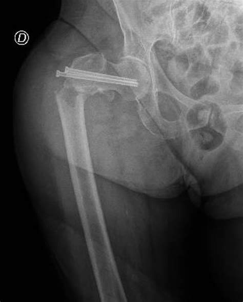 Preoperative Anteroposterior Radiograph Of The Right Hip Demonstrating Download Scientific