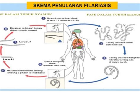 Kemenkes Sebut Minum Obat Paling Efektif Cegah Kaki Gajah Antara News