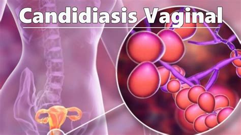 Candidiasis Vaginal Y Medicamento Que Debes Tomar Consultorio