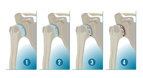 What Causes Arthritis In The Shoulder Kyle McClintock DO