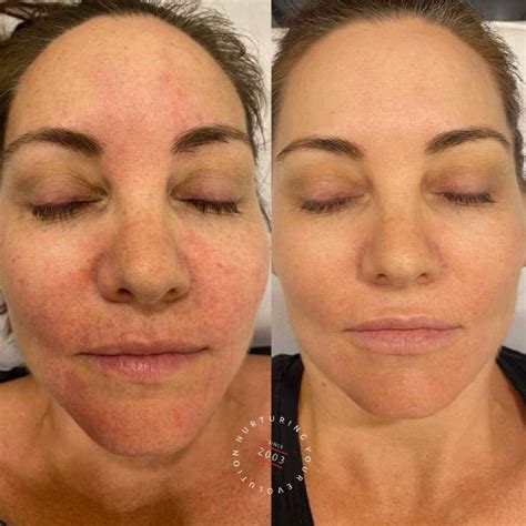 Treating Rosacea Laser Treatment For Rosacea Elc