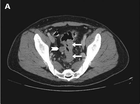 Synchronous Metastatic Rectal Cancer Completely Resected After