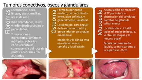 Tumores De La Cavidad Oral Y Orofaringe PPT