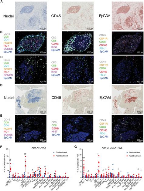 Multiplex Immunohistochemistry Of Pdacs Before And After Immunotherapy