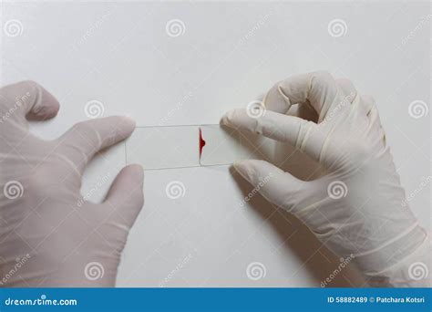 Blood Smear Under Microscopy Showing On Adult Acute Myeloid Leukemia
