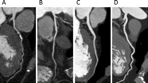 Improvement Of Spatial Resolution On Coronary Ct Angiography By Using