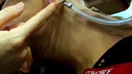 Co Fractional Laser Tighten Vagina Beautify Vaginal Medical Beauty