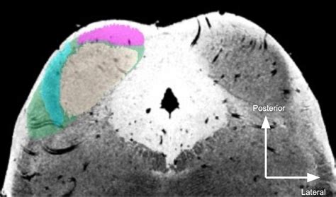 Inferior Colliculus Mri