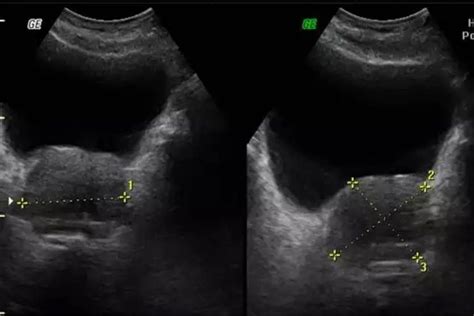 Protocolo De Ultrasonido De Próstata