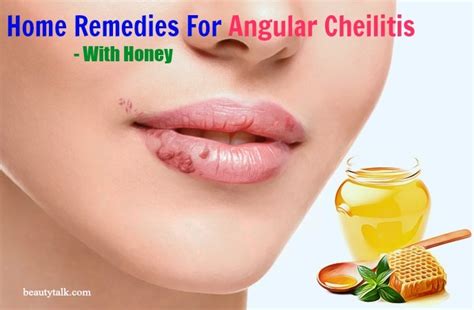 10 Natural Home Remedies For Angular Cheilitis Infection