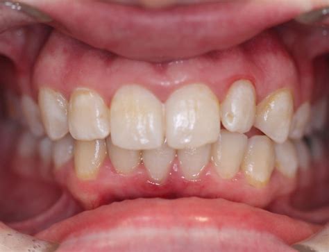 Clear Aligners Before and After Photos | MS Dental