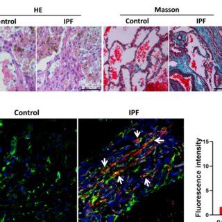 Lr Mscs Myofibroblast Transdifferentiation In Patients With Ipf A