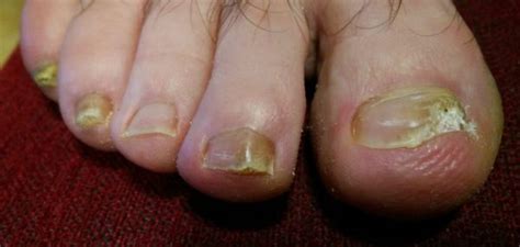 Onicomicosis hongos en las uñas de los pies Dra LOREA BAGAZGOITIA