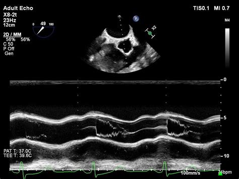 Systolic Anterior Motion Sam Of The Mitral Valve Left Ventricular