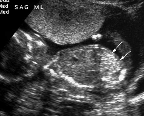 Intraabdominal Fetal Echogenic Masses A Practical Guide To Diagnosis