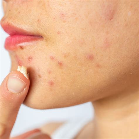 Nodular Acne Symptoms Causes And How To Treat It 53 Off