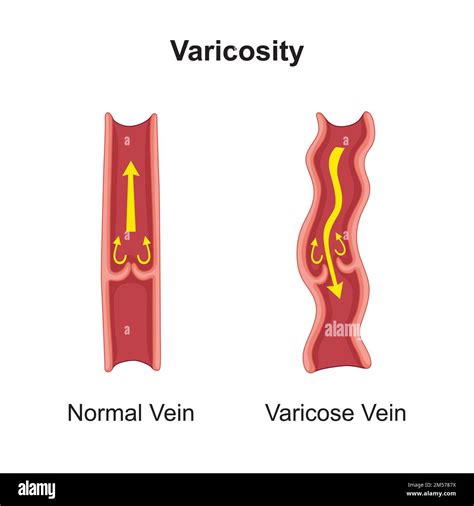 Varicose Vein Scientific Design Colorful Symbols Vector Illustration