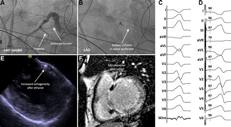 Ablation Of Ventricular Tachycardia Storm With Coronary Venous Ethanol