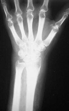 Imaging in Hypertrophic Osteoarthropathy: Overview, Radiography ...