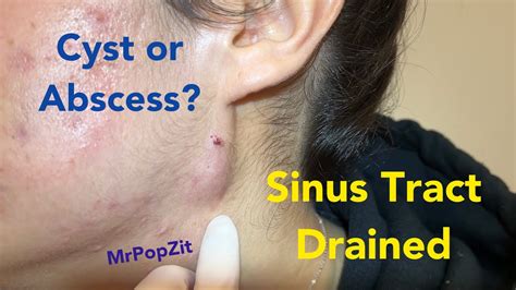 Sinus Tract On Face Drained Cyst Or Acne Nodule What Do You Think