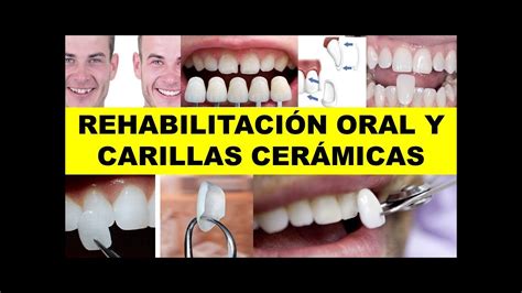 Rehabilitaci N Oral Y Carillas Cer Micas Youtube