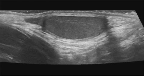 Cystic Dysplasia Of The Rete Testis Associated With Ipsilateral Renal