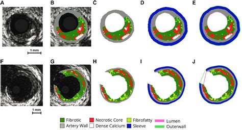 VH IVUS Imaging Processing Procedure Image Processing Steps Of VH IVUS